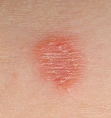 info about ringworm and the cure