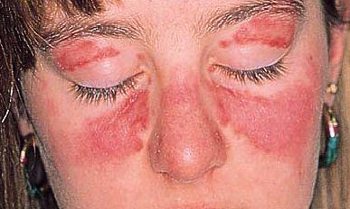 is rosacea a symptom of lupos