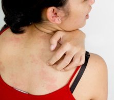 itchy back acne causes and treatment