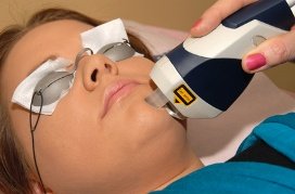 laser acne therapy