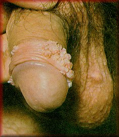 pics of genital warts