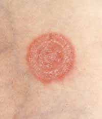 pictures of ringworm