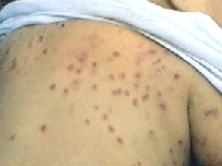 Scabies on Back