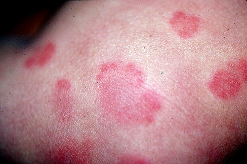 what hives look like