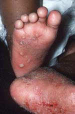 Scabies on feet picture